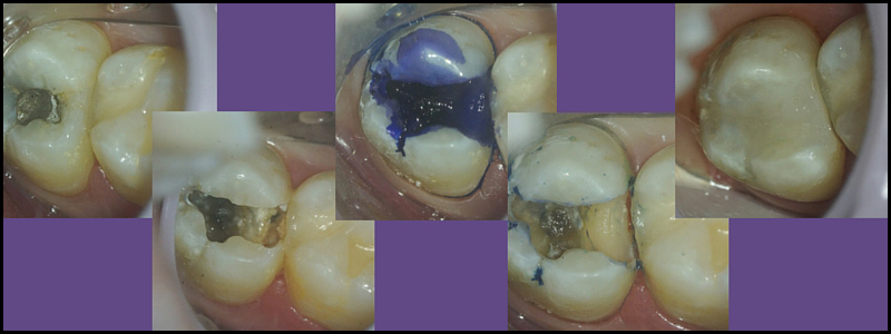 Tooth colored filling by Charlotte dentist Dr. Payet to fix a deep cavity