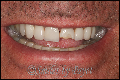 Porcelain veneers can break; 15 year old porcelain veneers