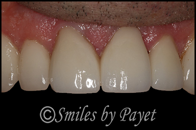 after porcelain veneers