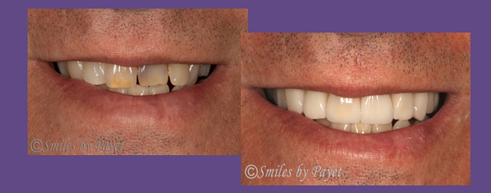 cosmetic dentistry with porcelain veneers by Charlotte dentist Dr. Payet