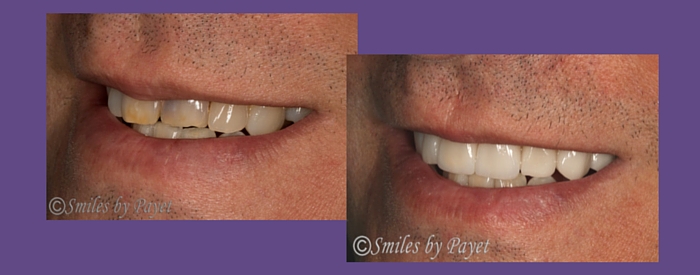 before and after porcelain veneers left side smile