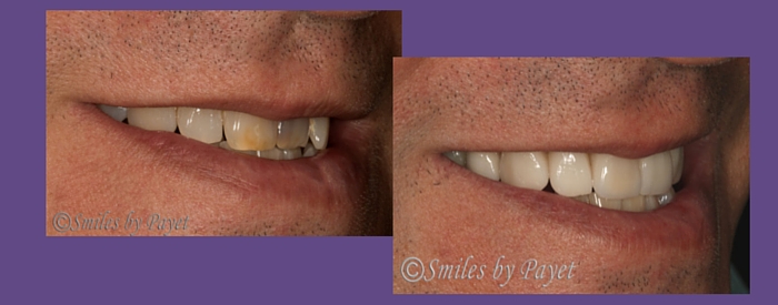 before and after porcelain veneers right side smile