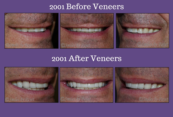 Before and After Veneers by Charlotte cosmetic dentist Dr. Payet