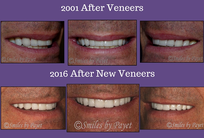 10 porcelain veneers; cosmetic dentist Charlotte NC