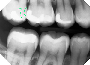 how fast can a cavity grown - before