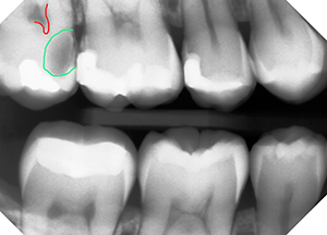 a small cavity turned very big in 14 months