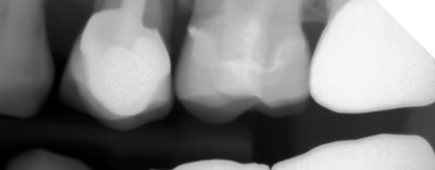 x-ray of 17yr old CEREC crown by Charlotte dentist Dr. Payet