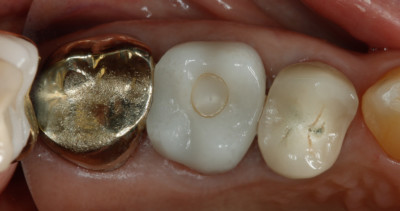 Top view of 17yr old CEREC crown by Charlotte dentist Dr. Payet