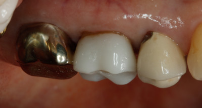 Side view of 17yr old CEREC crown by Charlotte dentist Dr. Payet