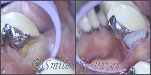 microscope enhanced dentistry