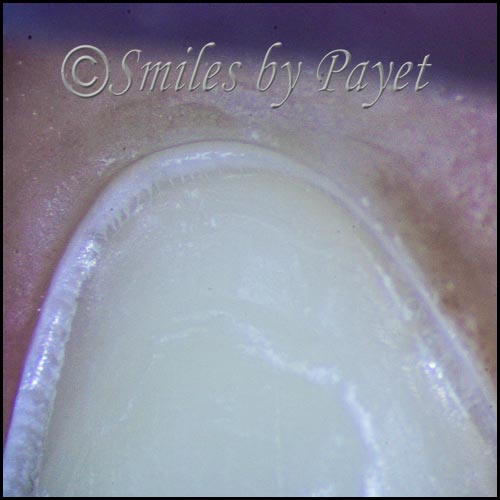 microscope enhanced dentistry is precise