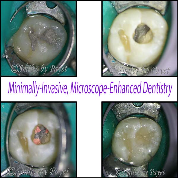 microscope enhanced dentistry root canal