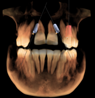 3D xray example showing dental implants by Charlotte dentist Dr. Payet