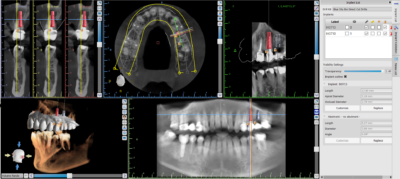 Virtual treatment planning of dental implants and crowns by Charlotte dentist Dr. Charles Payet