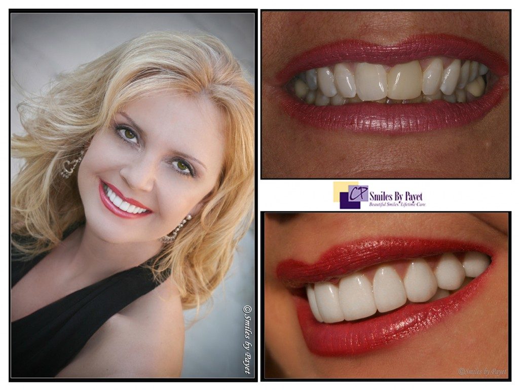 Twenty porcelain veneers