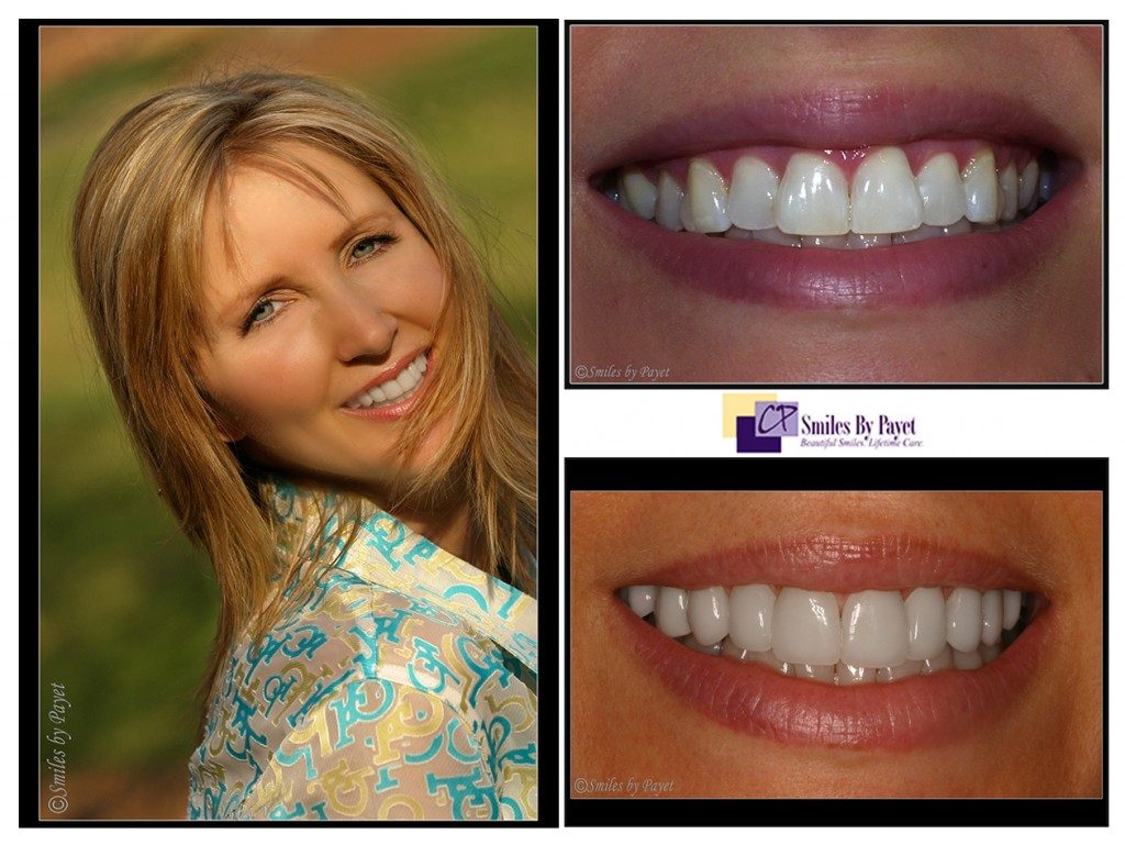 Ten porcelain veneers