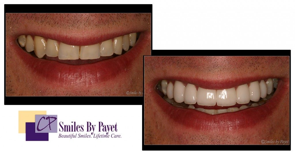 Dental veneers change tooth shape and color