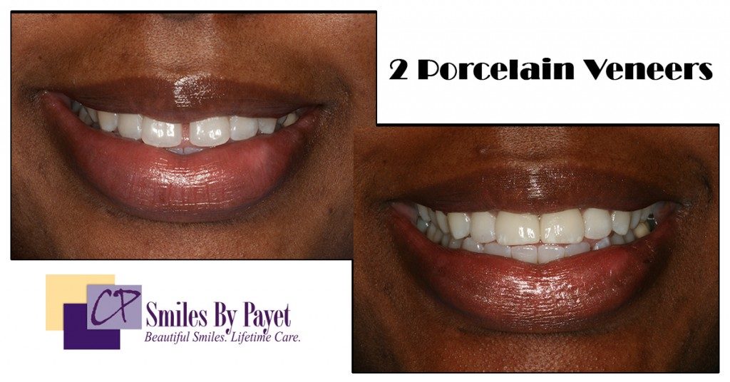 Close a gap between teeth with 2 veneers