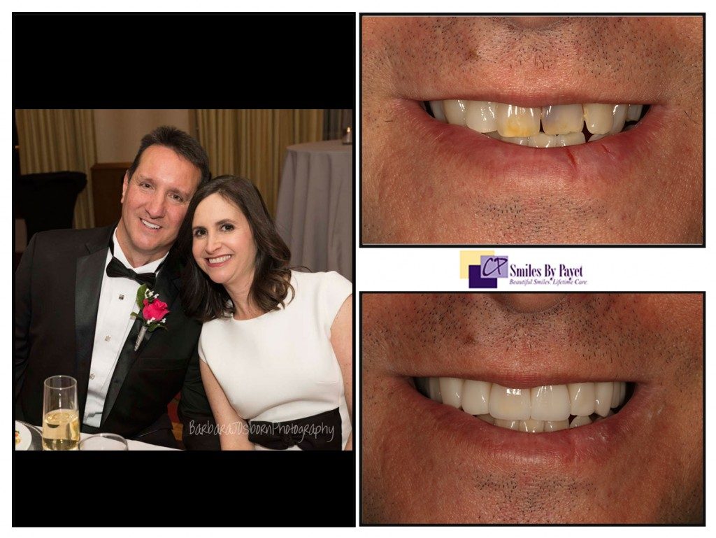 Porcelain veneers wedding makeover