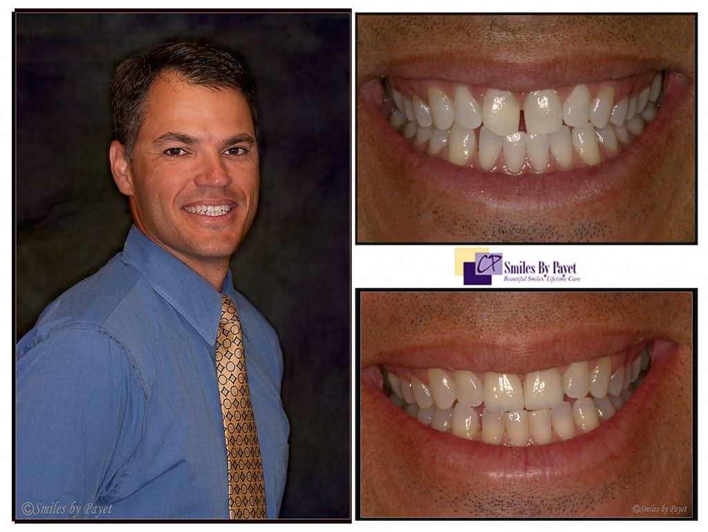 Conservative smile makeover 2 laminate veneers