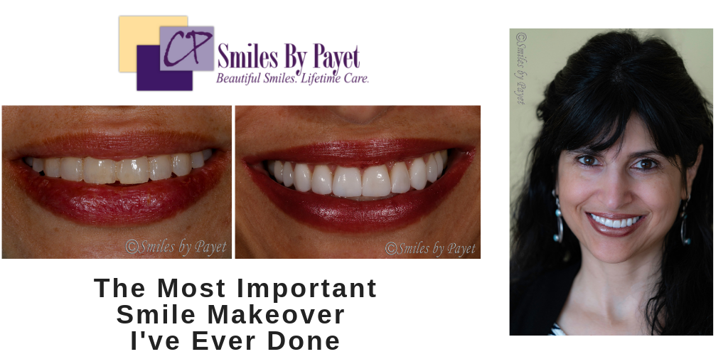 Cosmetic dentistry with porcelain veneers by Charlotte dentist Dr. Payet