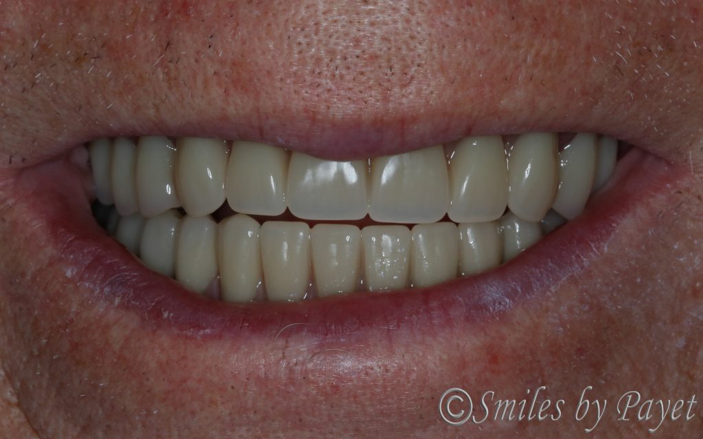 Charlotte dentist beautiful dentures, dental implant dentures