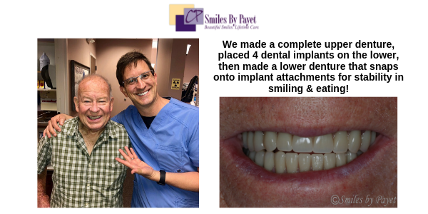 Charlotte dental implant overdentures