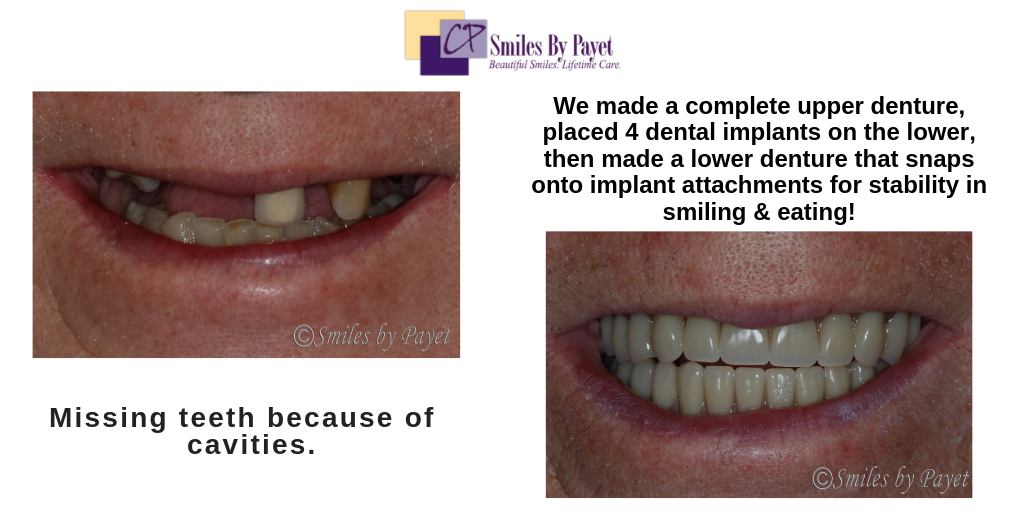 Dental implant overdentures by Charlotte dentist Dr. Payet
