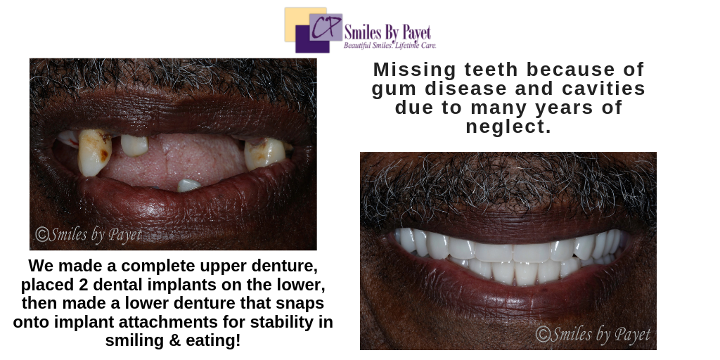 Beautiful dentures and implant dentures by Charlotte dentist Dr. Charles Payet