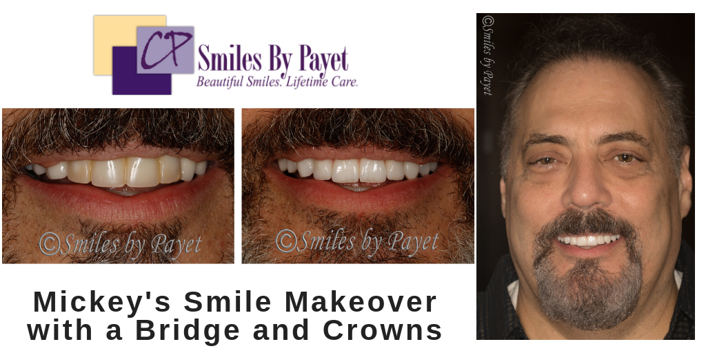 Dental bridge and crowns, cosmetic dentistry, charlotte nc