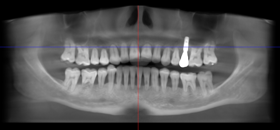 inflammatory root resorption after braces