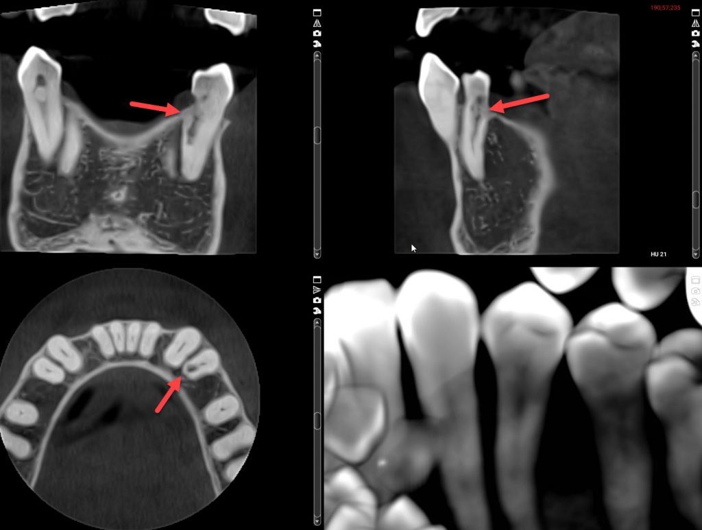 3D cone beam x-ray views, internal & external root resorption