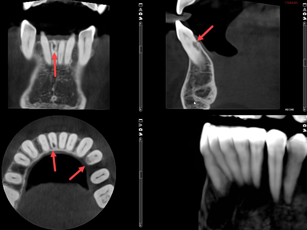 3D cone beam x-ray views, internal resorption lower front tooth