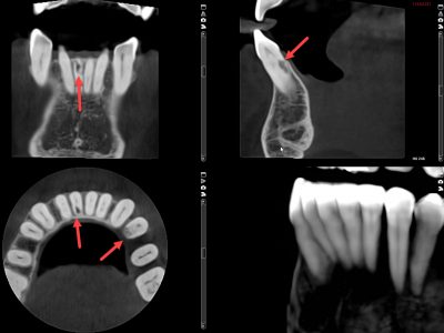 3D CT scans of teeth show details