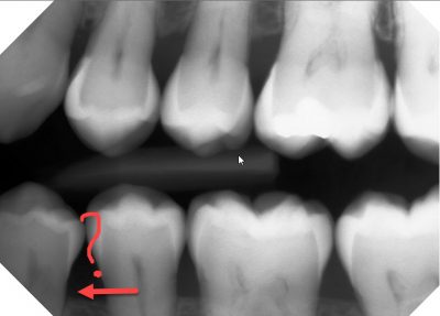 bitewing x-ray, doesn't show internal resorption