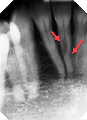 lower front tooth, internal root resorption 2D x-ray