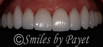 Emax all-porcelain crowns