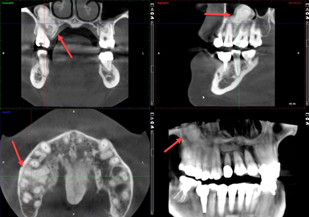 Can Dental X Rays See Through Crowns?