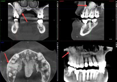 3D CT scan of bony jaw cysts