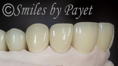 Zirconia all-ceramic crowns