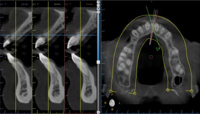 3D CT x-ray showing bone width & height