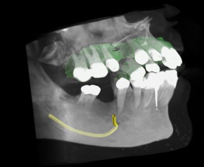 3D dental x-ray showing nerves