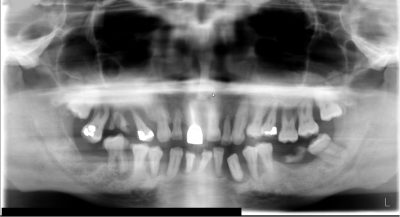 severe periodontal disease x-ray