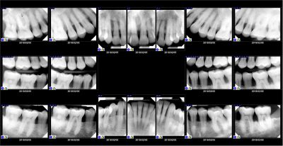 full mouth series of x-rays