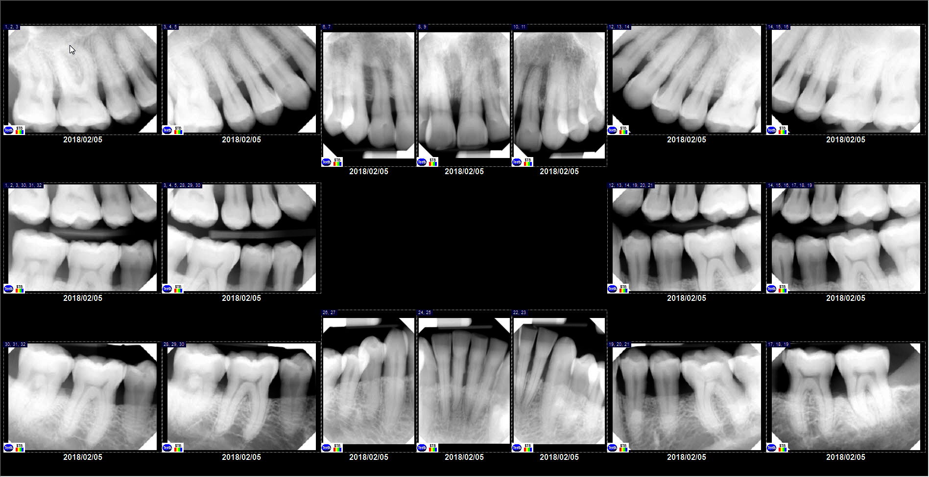 Full Mouth Series Template