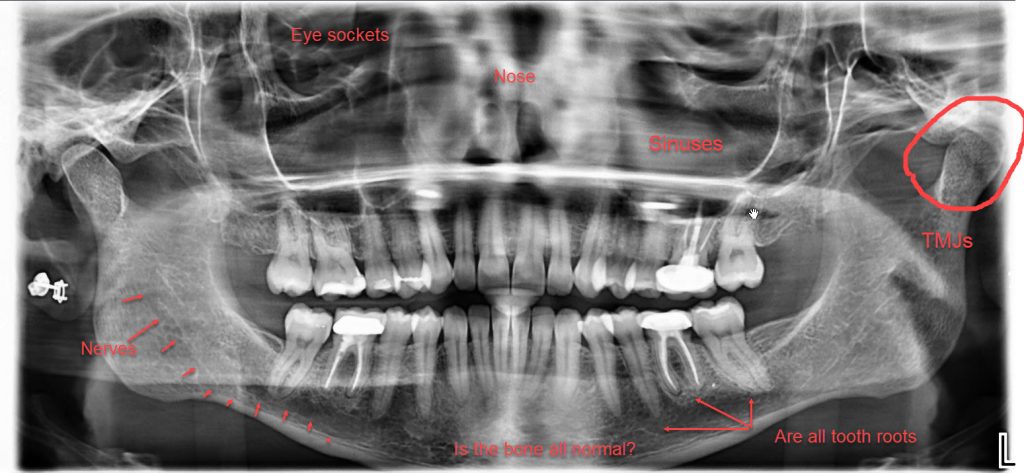 panoramic x-ray of a healthy patient