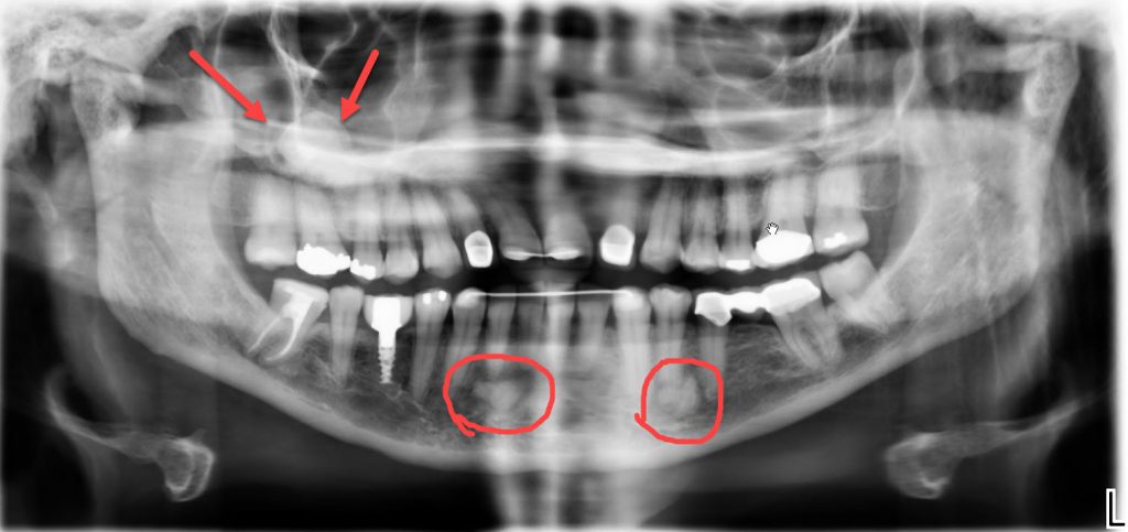 panoramic x-ray showing pathology