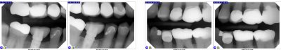 4 bitewing x-rays