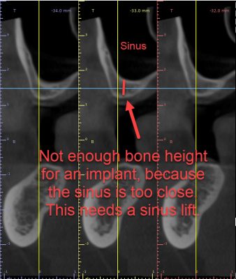 sinus lift needed before a dental implant