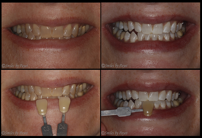 Teeth whitening tetracycline stains